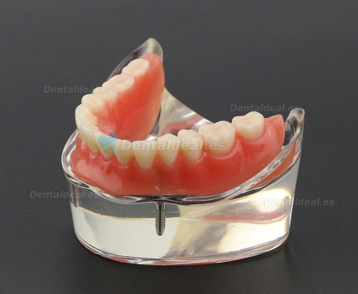 Dental Dientes inferiores Modelo de sobredentadura 2 Implantes Demostración Modelo 6002 01